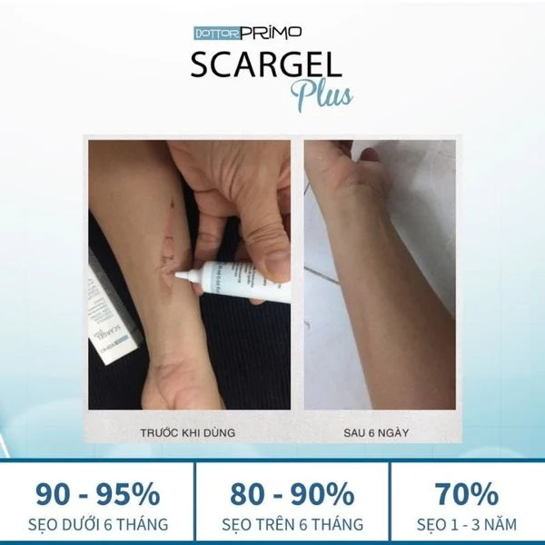 Gel dưỡng da DOTTORPRIMO Scargel Plus hỗ trợ mờ sẹo 16 Gel Dưỡng Da Dottorprimo Scargel Plus Hỗ Trợ Mờ Sẹo (1)
