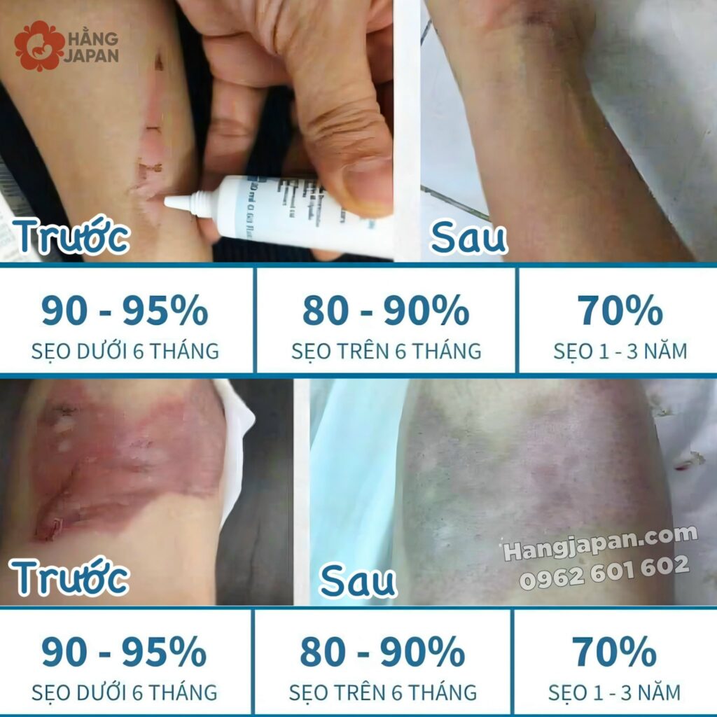 Gel dưỡng da DOTTORPRIMO Scargel Plus hỗ trợ mờ sẹo 21 Gel Dưỡng Da Dottorprimo Scargel Plus Hỗ Trợ Mờ Sẹo (2)